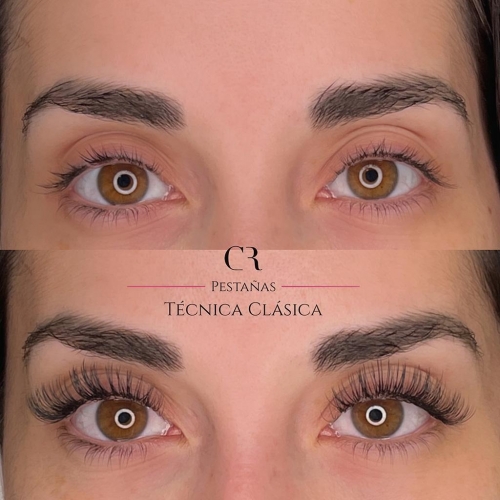 Extensiones Técnica Clásica